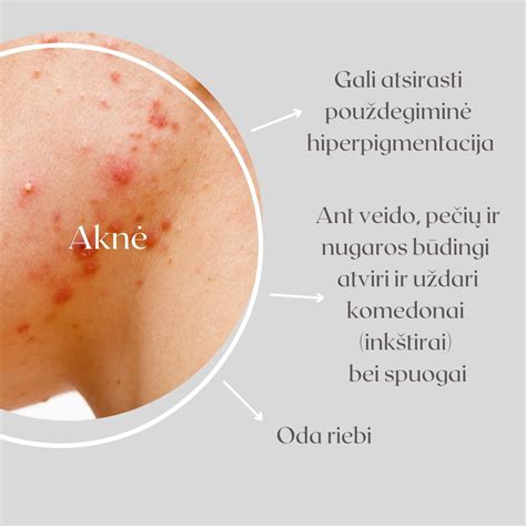 Uodo įkandimas ant vaiko odos