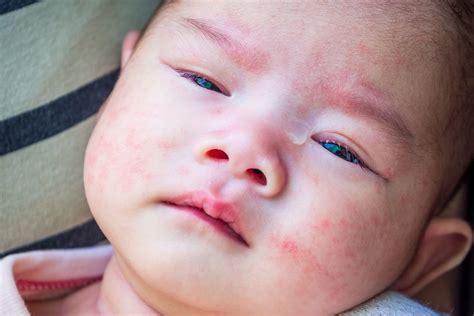 Atopinio dermatito pažeista kūdikio oda