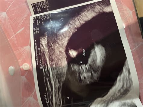 kūdikio lyties nustatymo metodai