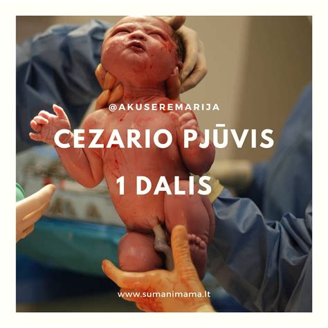 Cezario pjūvio operacijos schema
