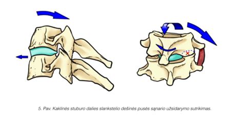 Klubų sąnarių padėtis nešioklėje