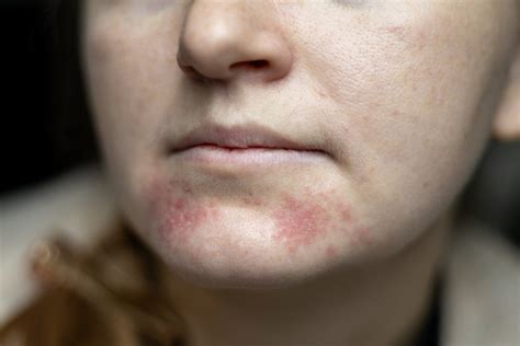 Perioralinio dermatito simptomai ant veido