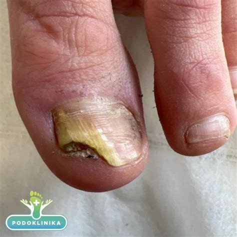 Nagų grybelio pažeistas nagas