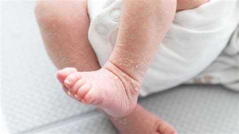 Naujagimio oda su angelo bučinio žyme ant kaktos