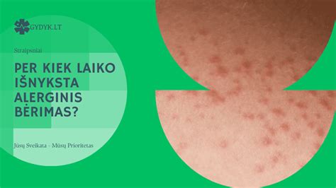 Schema, iliustruojanti skirtumus tarp alerginio bėrimo ir odos dirginimo