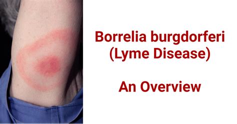 Erkė Borrelia burgdorferi