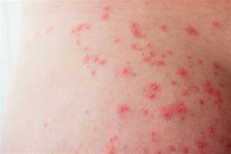 Alergijos simptomai ant kūdikio odos