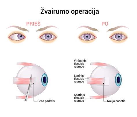 Akies raumenų operacija