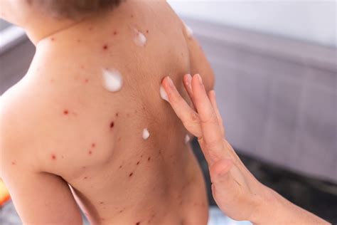 Vėjaraupiais sergančio vaiko pūslelės