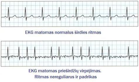Vaikų širdies ritmo sutrikimai (infografika)