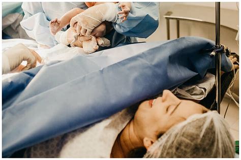Cezario pjūvio operacijos metu, ištraukiant naujagimį