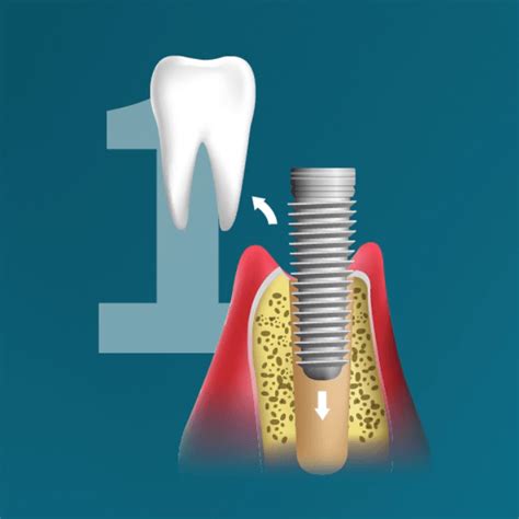 Apvaisinimo ir implantacijos etapai