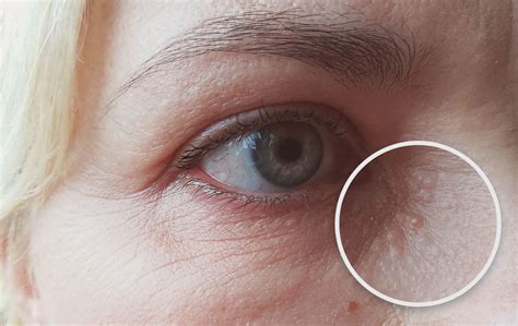 Balti naujagimio spuogeliai (miliumai)