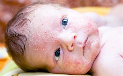 Kūdikio prakaitinis bėrimas