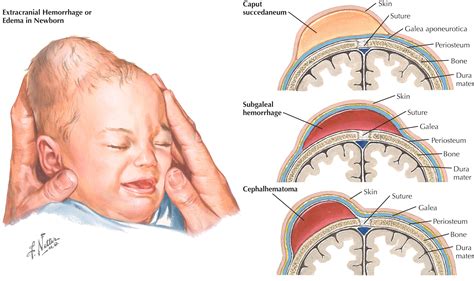 kūdikio kefalohematoma