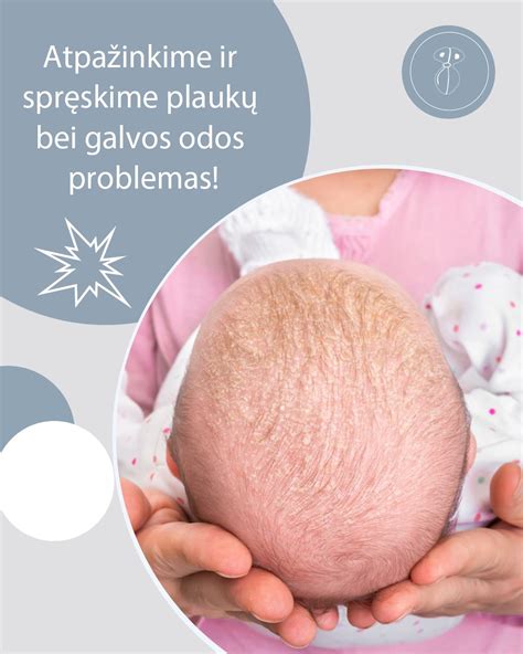 prakaitinio bėrimo pavyzdžiai ant kūdikio odos