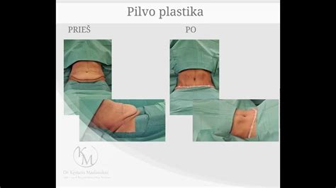 Pilvo plastikos operacijos schema