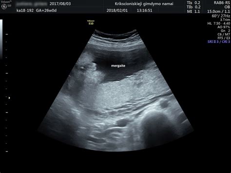 Ultragarsinis vaisiaus kaklo matavimas