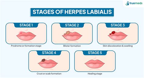 Lūpų pūslelinės (herpes labialis) atsiradimo stadijos