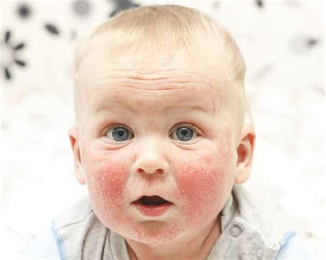 Kūdikis su atopiniu dermatitu