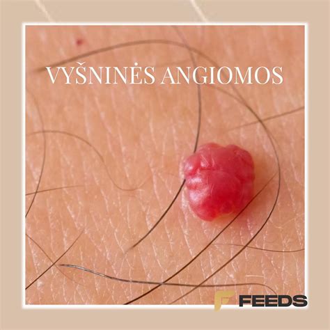 Voratinklinės angiomos nėštumo metu