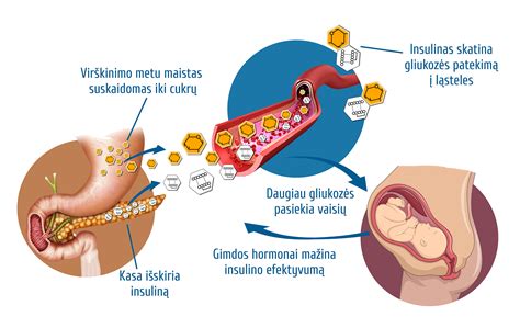 placentos vieta gimdoje schema