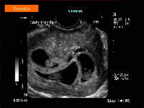 Placentos pirmeiga ir atšokimas