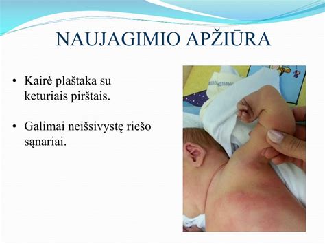 Naujagimio apžiūra dėl sėklidžių padėties