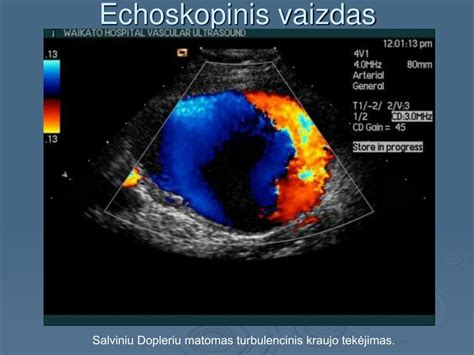 Placentos pirmeigos echoskopinis vaizdas