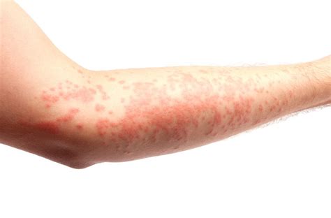 Alerginis kontaktinis dermatitas ant kūdikio odos