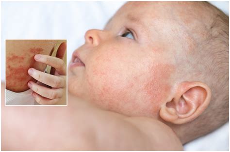 Atopinis dermatitas (egzema) kūdikiams