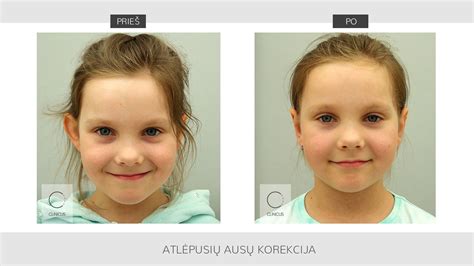 Atlėpusių ausų tipai ir priežastys