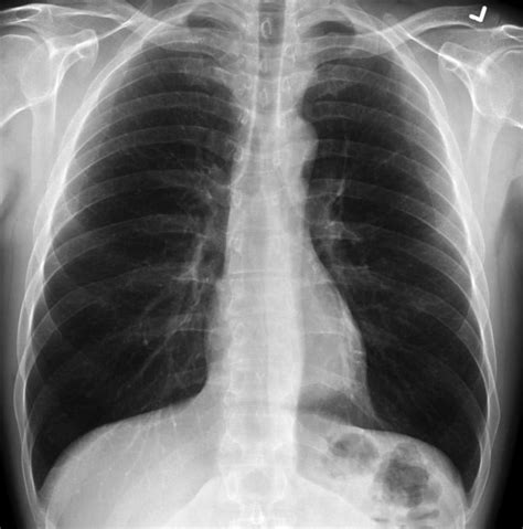 Plaučių rentgenograma su bronchiolito požymiais