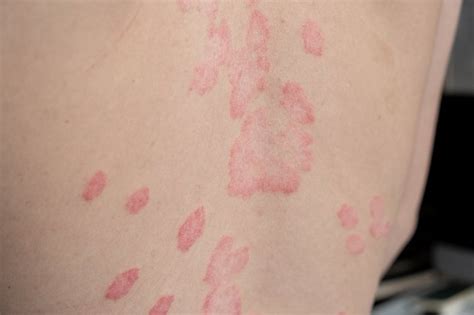 Psoriazės paveikta oda su plokštelėmis ir žvyneliais