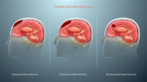 Subchorioninė hematoma ultragarso nuotraukoje
