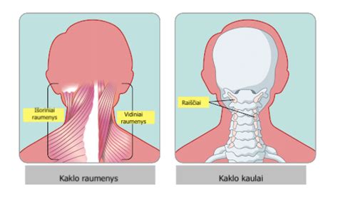 Kūdikio galvos dydis ir kaklo raumenų silpnumas
