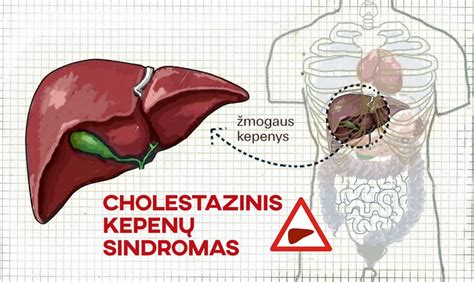 Nėščiosios kepenų cholestazės vystymasis