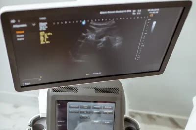 Ultragarso nuotrauka, rodanti besivystantį vaisių po tariamo persileidimo