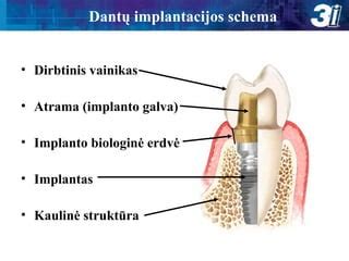 Dantų implantacijos schema