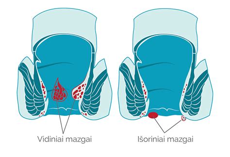 Hemorojus vs išangės įplėša