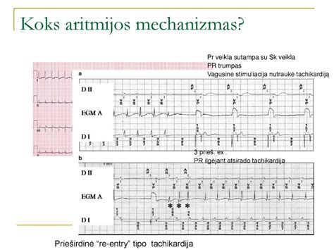 Naujagimio EKG, rodanti supraventrikulinę tachikardiją
