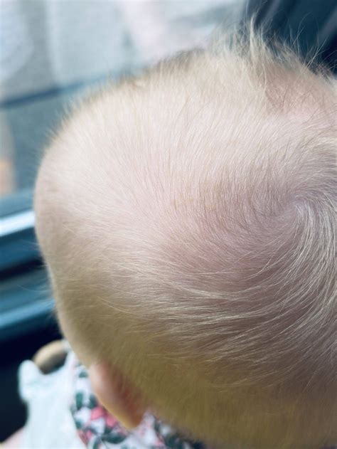 Artimas kūdikio galvos vaizdas su pleiskanų luobele