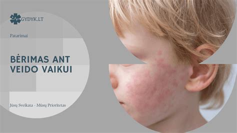 Ryškus parvoviruso bėrimas ant vaiko skruostų