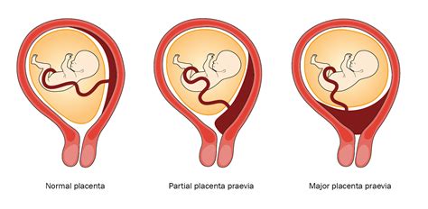 Placentos pirmeigos (placenta previa) tipai