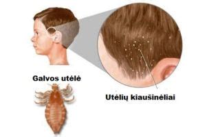 Glindos ir utėlės plaukuose