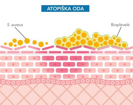 atopiniu dermatitu pažeistos odos zonos