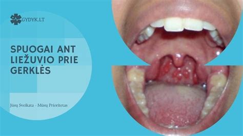 Schematinis Peirono ligos vaizdas