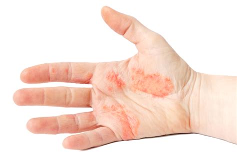 kontaktinio dermatito požymiai