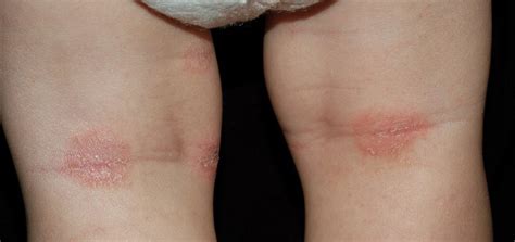 atopinis dermatitas ant kūdikio skruostų