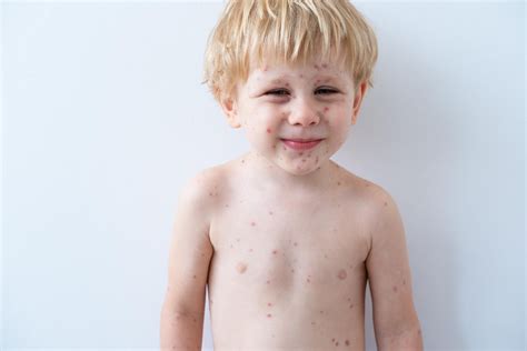 Tepalo aplikavimas ant vaiko odos